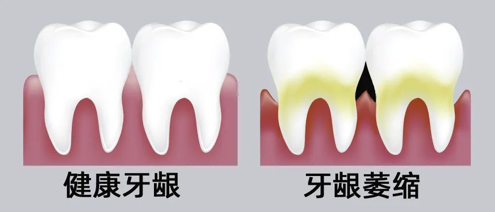 牙縫大露出“黑三角”，既塞牙又難看！還能恢復(fù)嗎？